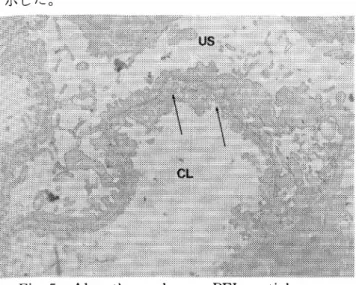 Fig. 5  Alport’s syndrome.  PEI  particles are  irregularly  present  on  the  splitted  basement membrane （ ↑ ）． （ × 10,000) 