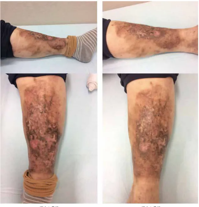 Figure 2   Postoperative left leg ulcer progress