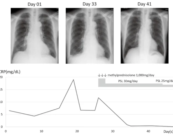 Fig. 2 The clinical course of chest X-ray and C-reactive protein with steroid therapy.