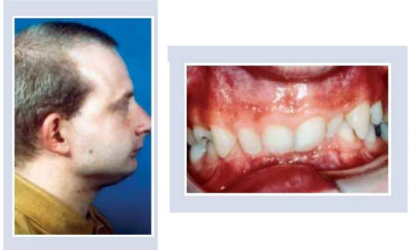 Gambar 9. Individu dengan tinggi wajah anterior bagian bawah yang besar cenderung  memiliki openbite anterior1 