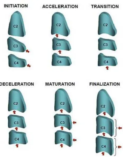 Gambar 11. Tahapan maturitas tulang vertebra servikalis menurut lamparski20 