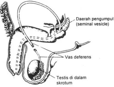 Gambar 2.8 Kontrasepsi dengan cara tubektomi pada wanita (Liewellyn, 2009) 