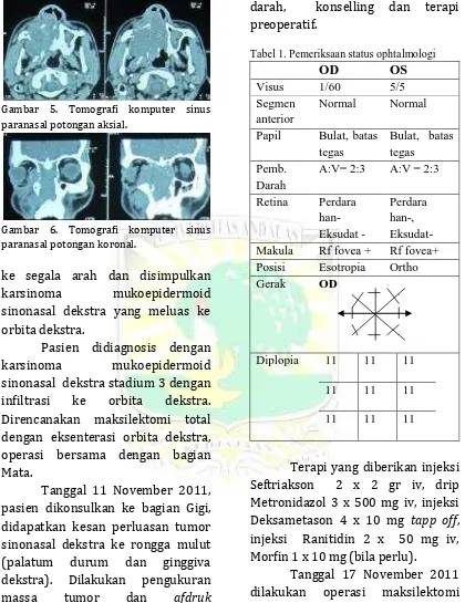 Tabel 1. Pemeriksaan status ophtalmologi  OD OS 