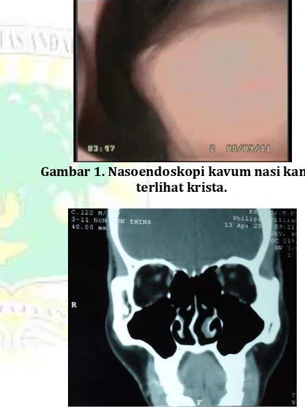 Gambar  2. Tomografi komputer sinus paranasal potongan koronal terlihat deviasi septumke kanan 