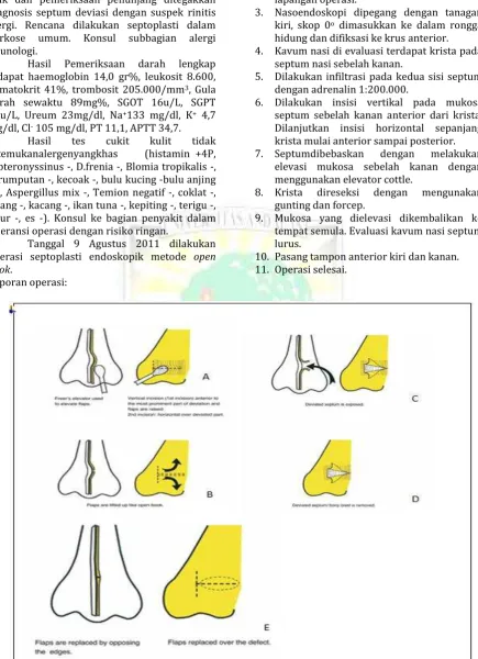 Gambar 3. Prosedur septoplasti metode open book10 