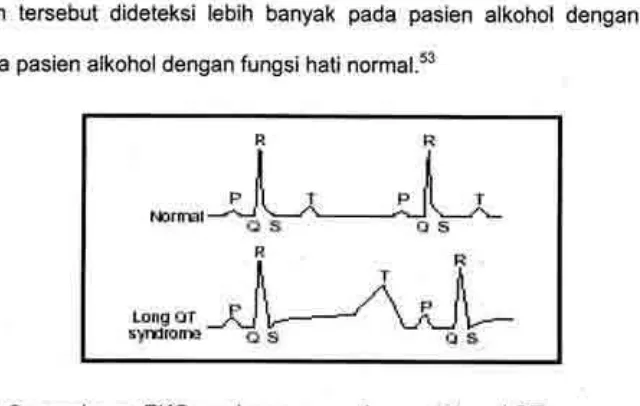 Gambar 6 : gambaran EKG syndroma pemanjangan interval QT.