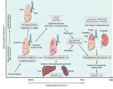 Gambar 2.1. Patogenesis TB Paru 