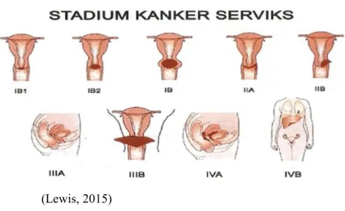 Gambar 2.1. Stadium Kanker Serviks