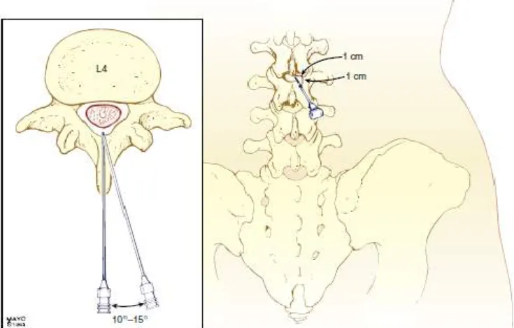 Gambar 2.1.3 Lokasi Injeksi Anestesi Spinal 