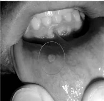 Figure 5.1 Aphthous stomatitis (canker sore). This image can be found in color in the app.