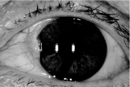 Figure 5.6 Severe pterygium. This image can be found in color in the app.
