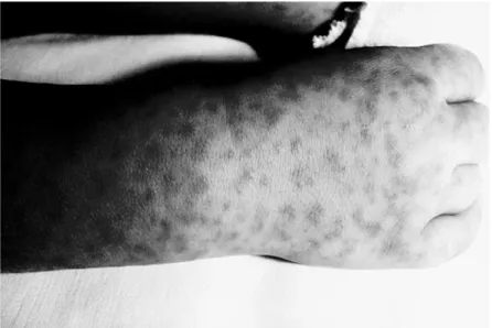 Figure 6.1  Rocky  Mountain  spotted  fever  (later  stage  rash).  This  image  can  be  found  in color in the app.