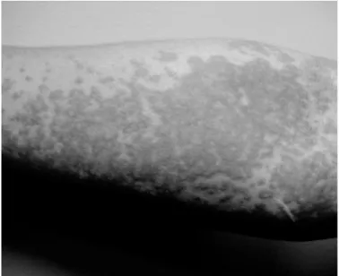 Figure 6.4 Urticaria. This image can be found in color in the app.