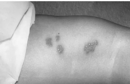 Fig. 10.1. Herpes simplex virus skin blisters on a patient’s arm. (See Fig. 1 in colour plate section)