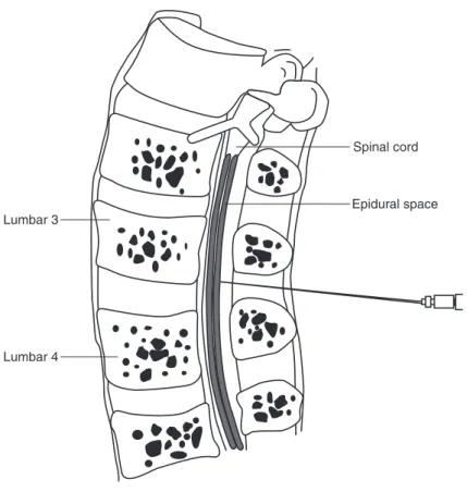 Figure 5.4  The epidural space