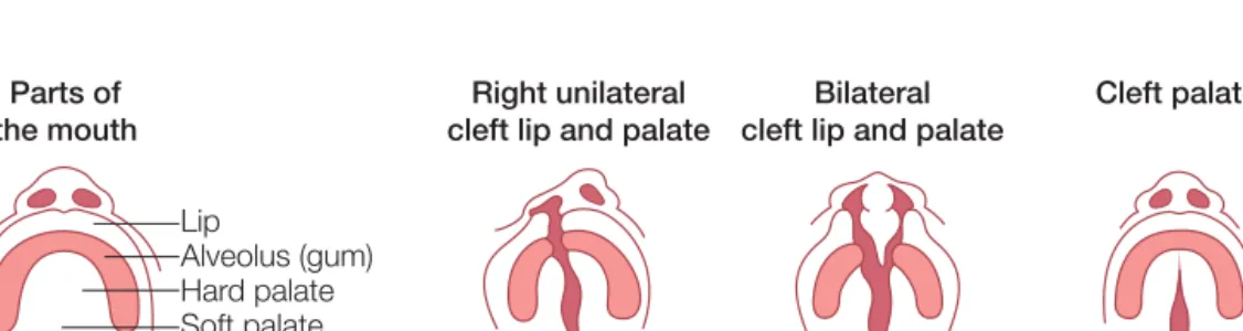 Figure 4.1    Cleft lip and palate. (From Cleft Lip and Palate Association, www.clapa.com, with permission)
