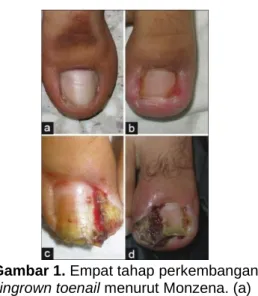 Gambar 1. Empat tahap perkembangan  ingrown toenail menurut Monzena. (a) 