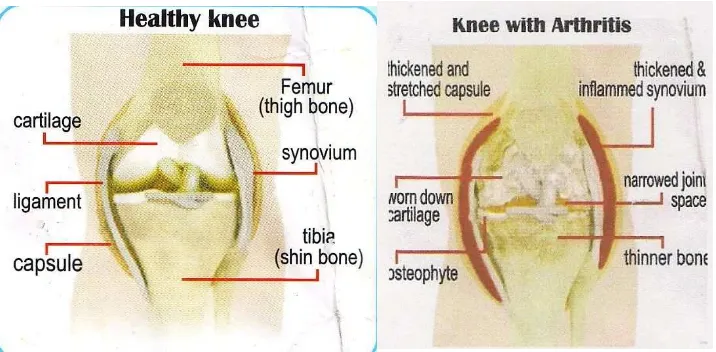 Gambar 1. A Kiri : Gambar Sendi Lutut Normal.B. Kanan :gambar  sendi lutut yang mengalami osteoartritis