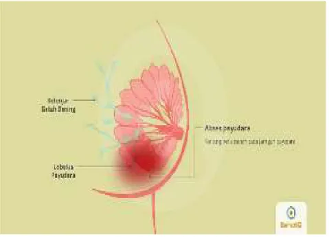 Gambar 5. Abses / Mastitis  Payudara 