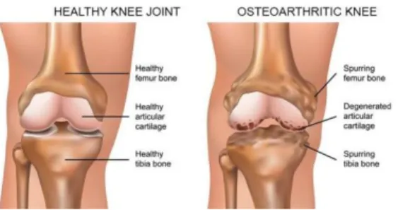 Gambar 2.2 Perbedaan tulang normal dan osteoarthritis (Susanti & 