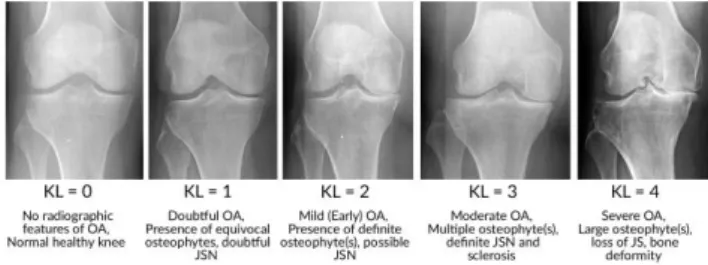 Gambar 2.3 Radiologis Grade Osteoarthritis berdasarkan grade Kellgren- Kellgren-Lawrence (Kohn et al., 2016) 