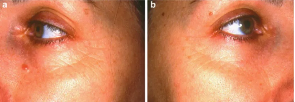 Fig. 4.3  A woman in her late twenties was treated once daily for 4 months (a) on the left side of  the face with vehicle cream and (b) on the right side of the face with vitamin C (15%)