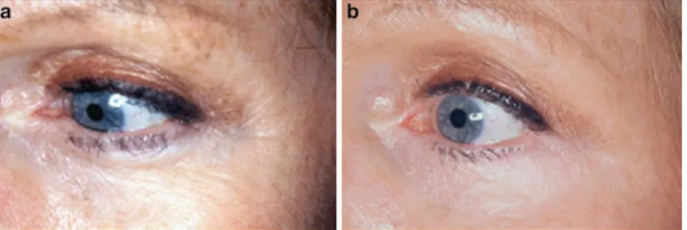 Fig. 4.6  This woman in her early 1940s was photographed (a) before treatment and (b) after treatment  with topical d-a-tocopherol (5%) once daily for 4 months