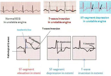 Gambar 2.2. Gambaran EKG Unstable Angina, STEMI, NSTEMI Sumber : Wadud, A. 2013. 