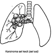 Gambar 2.4 Small Cell Lung Carcer (SCLC) jenis Karsinoma Sel Kecil
