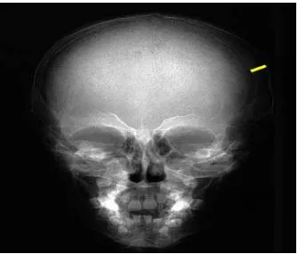 Gambar 3. Gambaran radiografi pada anak laki-laki, usia 5 tahun dengan thalassemia  