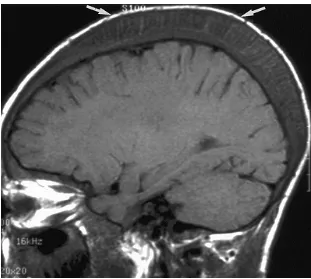 Gambar 6. Gambaran sagittal T1-weighted (MRI) pada anak laki-laki berusia 10 tahun.  