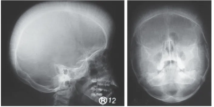 Gambar 7. Tampilan hair-on-end dengan derajat eritropoiesis extrameduler yang hebat.12 