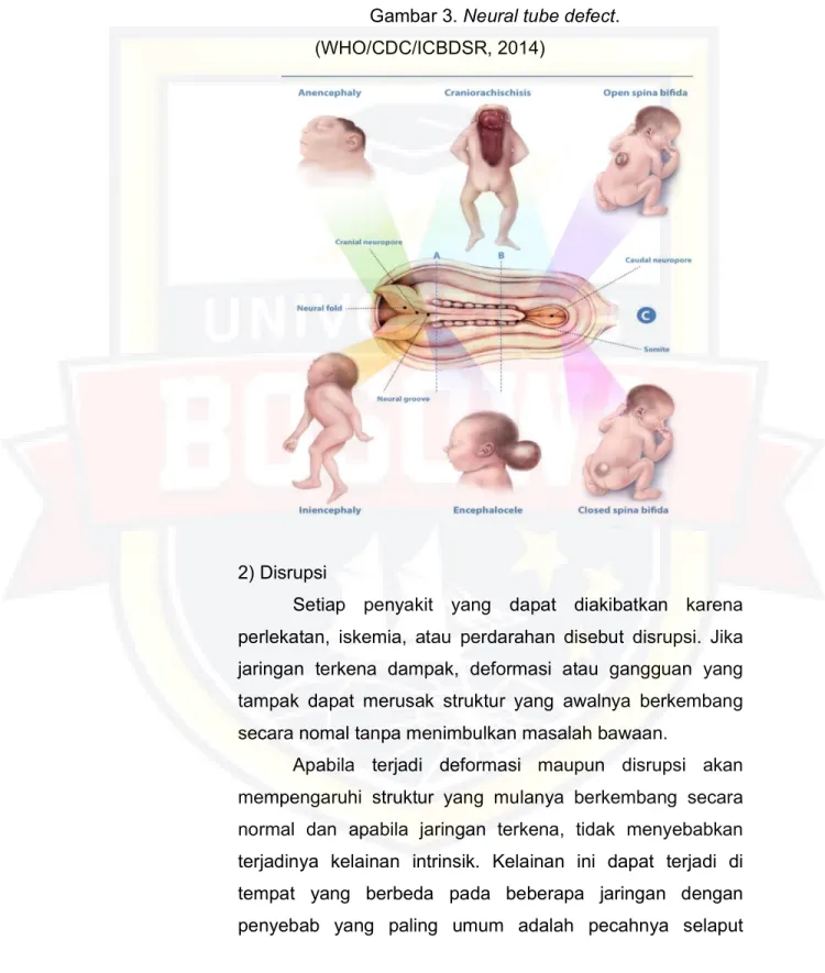 Gambar 3. Neural tube defect. 