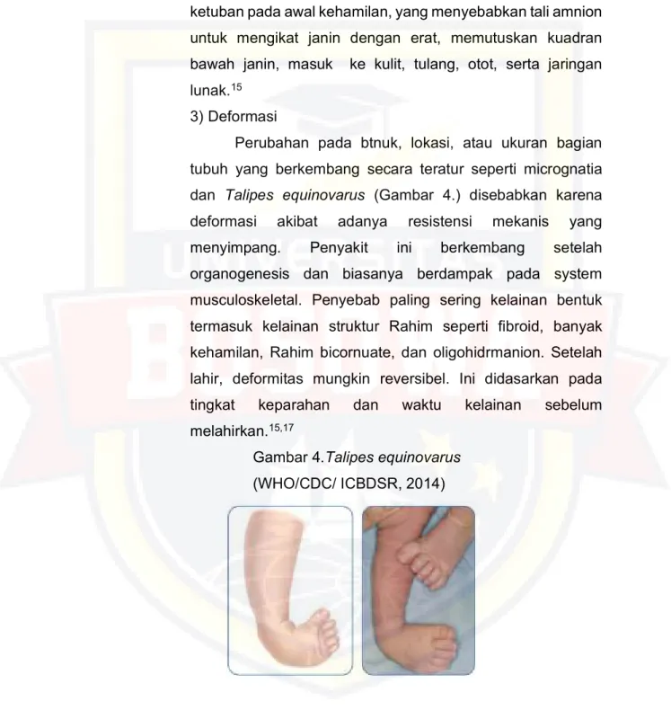 Gambar 4.Talipes equinovarus   (WHO/CDC/ ICBDSR, 2014) 