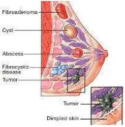 Gambar 6. Anatomi Tumor Payudara (http://www.asco.com/) 