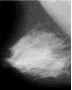 Gambar 8. Contoh Gambar Mammogram mdb001.pgm 