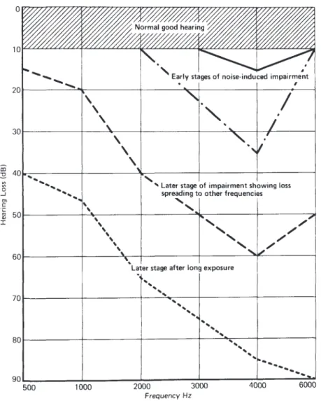 Figure 5.  Audiograms showing different stages of noise induced hearing loss after Bell