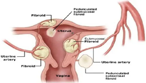 Gambar 2.2 Tempat letak Mioma uteri 