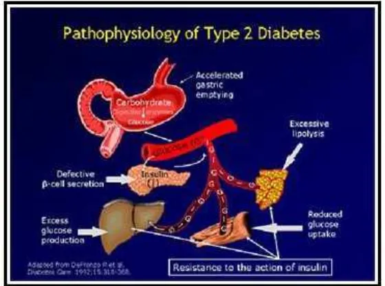 Gambar 2.2: Patofisilogi Diabetes Mellitus Tipe 2 