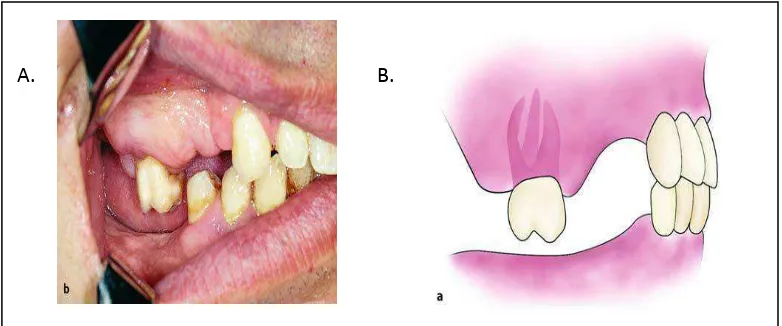 Gambar 1. Gigi posterior yang tinggal sendiri mengalami ekstrusi atau supraerupsi yang memerlukan tindakan khusus