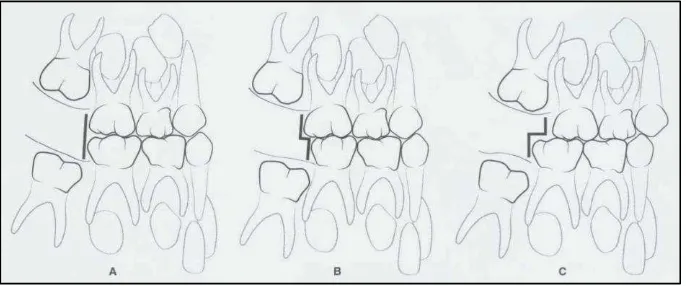 Gambar 6. Tiga tipe hubungan molar pertama permanen: (A) 