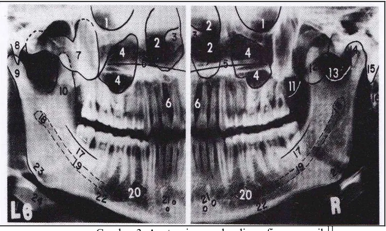 Gambar 3. Anatomi normal radiografi panoramik11 Keterangan : 1. Rongga orbita, 2. Rongga hidung, 3