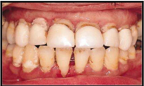 Gambar 1. Gambaran klinis priodontitis kronis17 