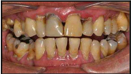Gambar 2. Periodontitis kronis pada perokok17  