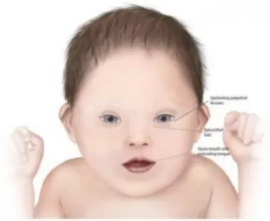 Gambar 1. Visual anak penyandang Down Syndrome 