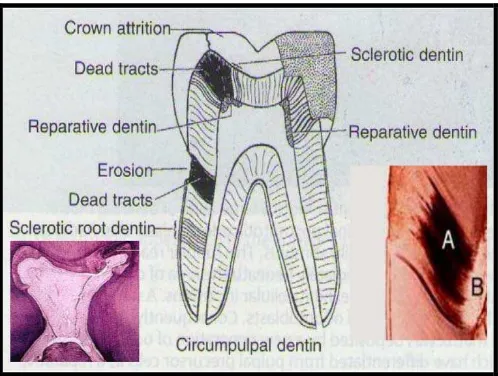 Gambar 6. A. Dentin reparatif; B. Dentin sklerotik8 