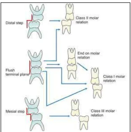 Gambar 1. Pengaruh terminal plane  pada         hubungan molar gigi permanen6 