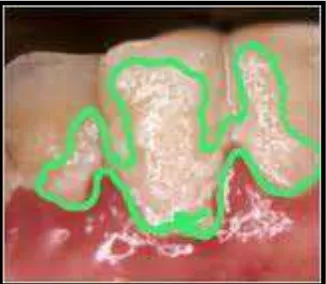 Gambar 3. Deposisi plak pada permukaan gigi26 