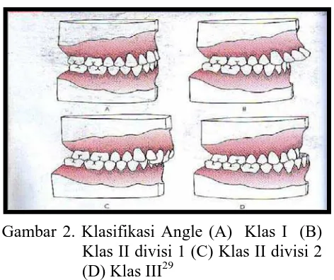 Gambar 2. Klasifikasi Angle (A)  Klas I  (B) Klas II divisi 1 (C) Klas II divisi 2 