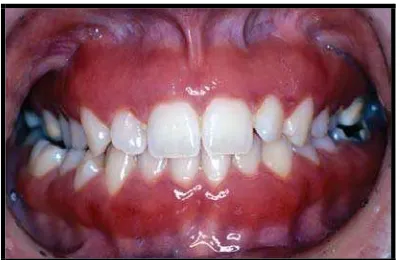 Gambar 2. Gingiva dalam keadaan inflamasi1 